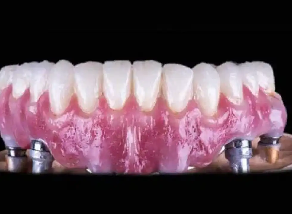 Top Reasons To Consider Same Day Dental Implants